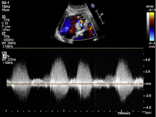 Acquired Gerbode Defect After Aortic Valve Endocarditis