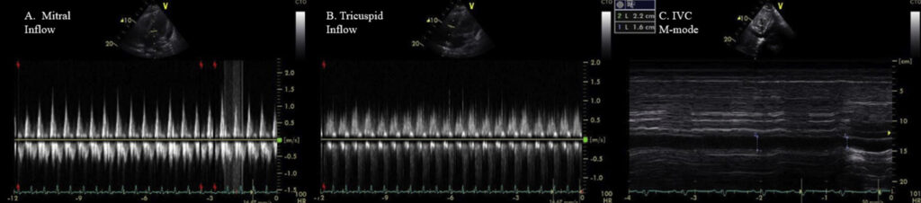 Granulomatosis With Polyangiitis With Pericarditis — Mitral & Tricuspid Inflow Doppler